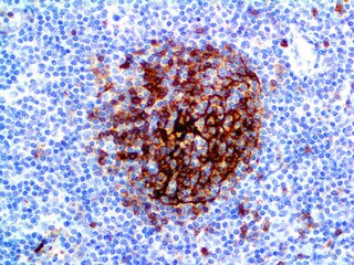 IHC of CD23 on an FFPE Lymphoma Tissue